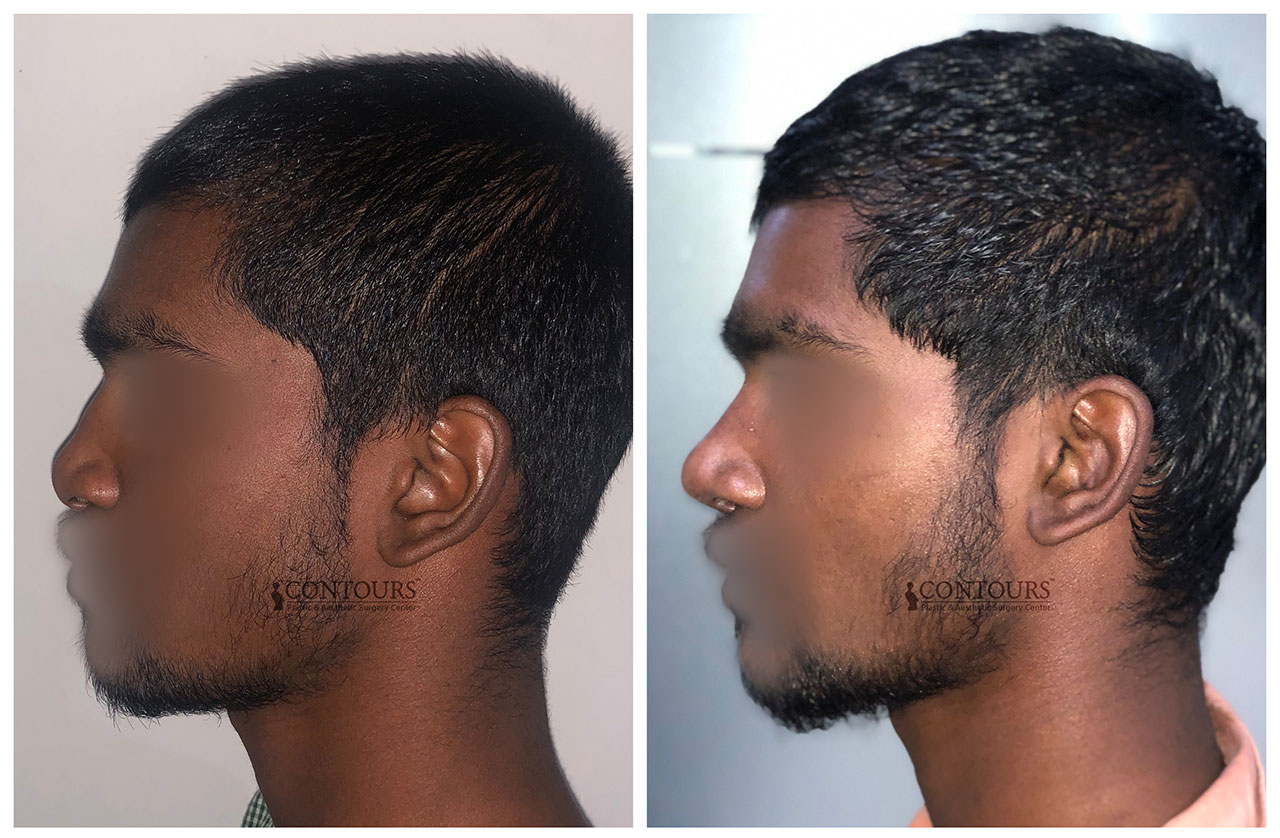 Before and after images of a successful tip rhinoplasty.