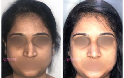 Crooked Nose Deformity, Deviated Noses