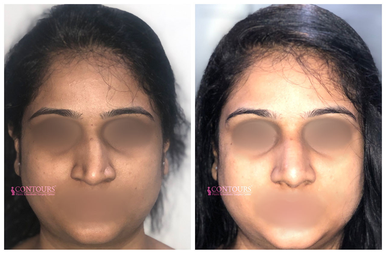 Before and after photos of a corrected crooked nose through surgery.